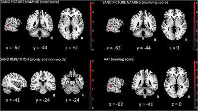 Frontiers Neuroanatomical Correlates Of Screening For Aphasia In